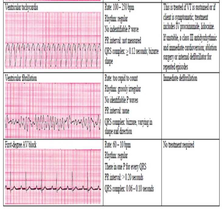 Ekg practice exam with answers