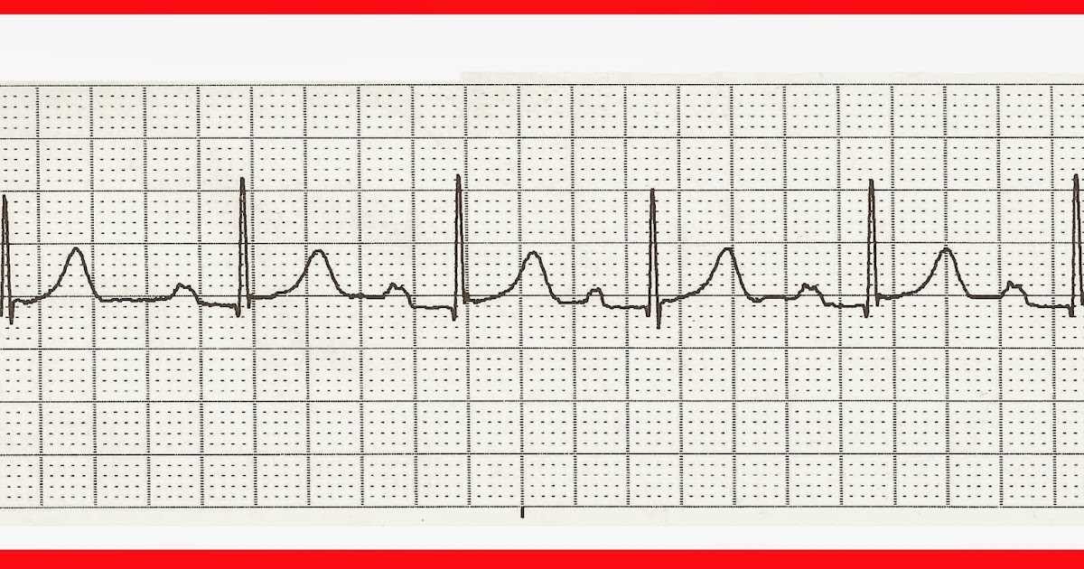 Ekg practice test with answers