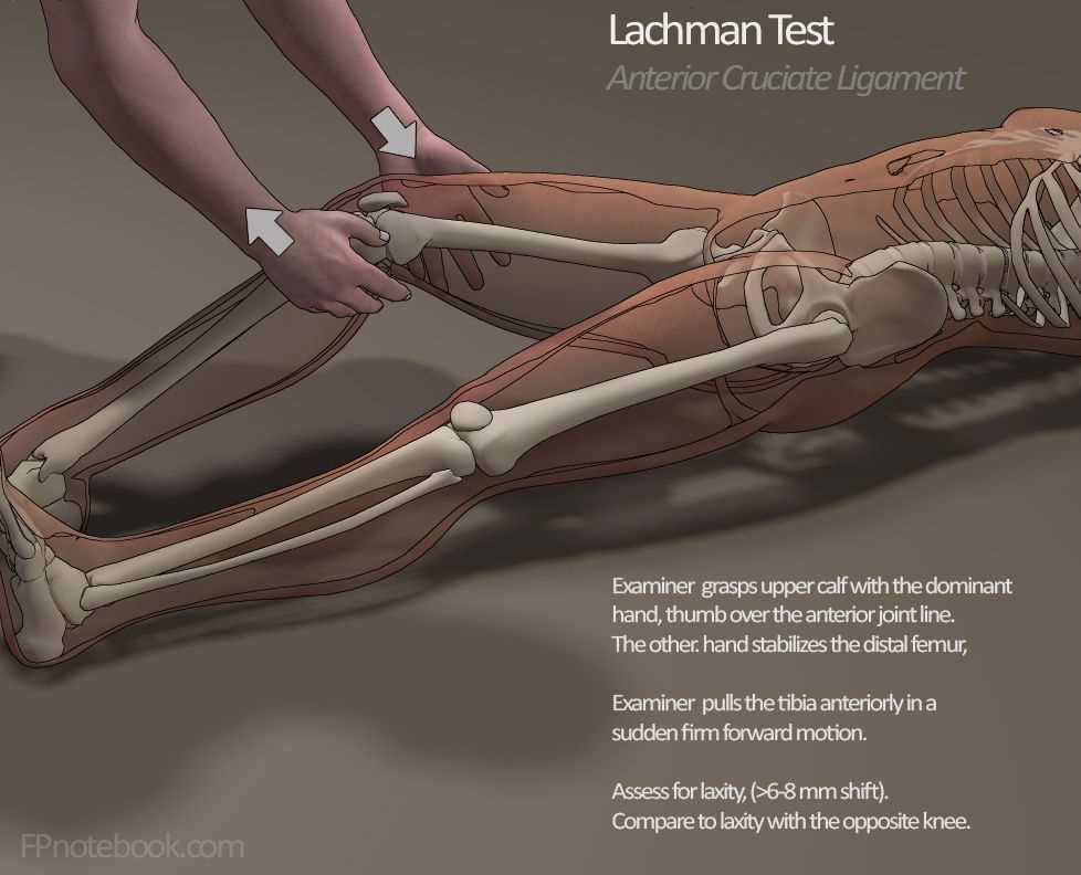 ACL Integrity Assessment: Determining the Stability of the Anterior Cruciate Ligament