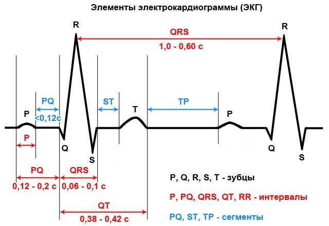 3. Ventricular Tachycardia