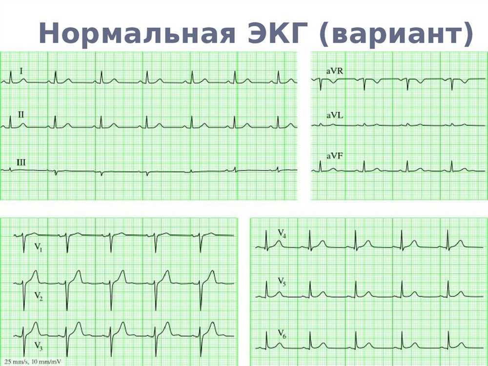 Common EKG Lab Quest 12 Patterns and Their Significance