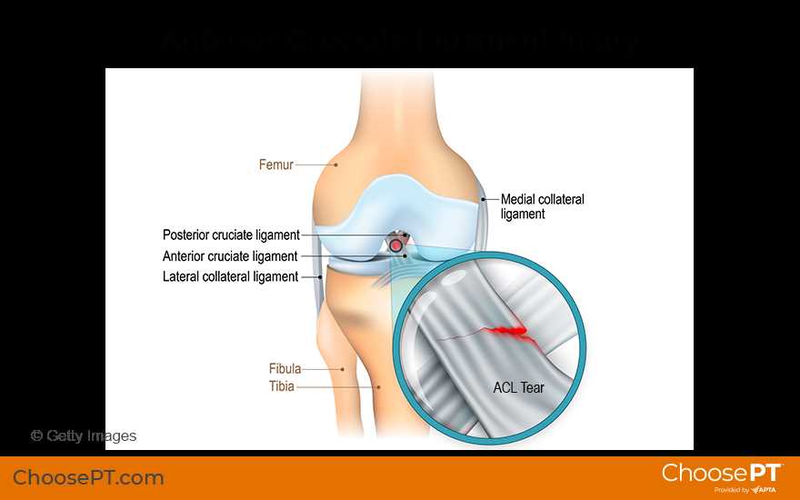 Why is it important to assess ACL integrity?