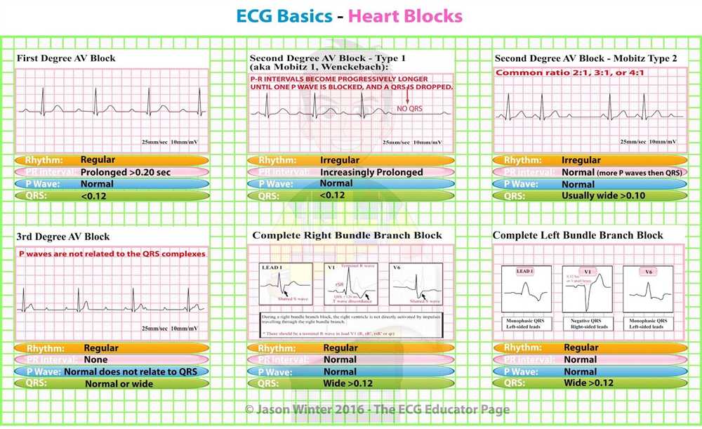 Common ECG Activity Terminology