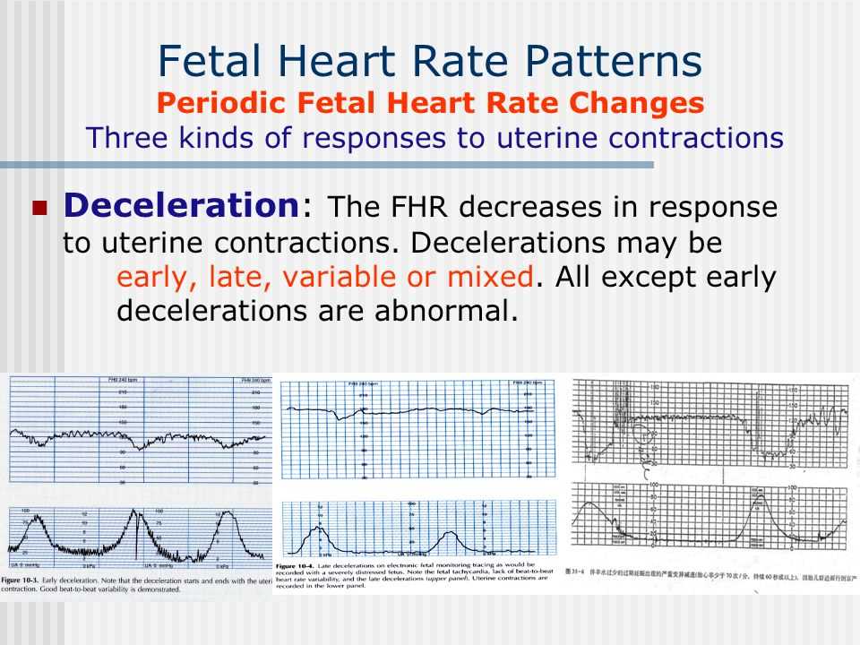 Understanding the importance of fetal heart monitoring